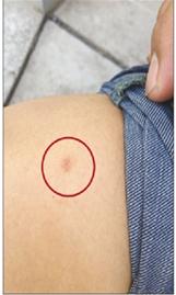 北京男子打车疑被含艾滋病毒针头扎伤(图)